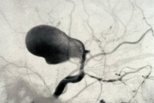 Aneurysm, carotid tip