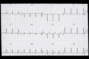 view ECG minimal ST abnormalities