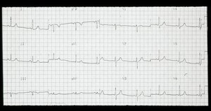 view Normal ECG, at rest