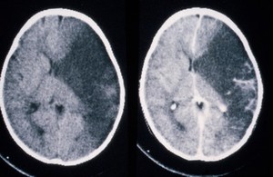 view Myocardial infarct left due to arteritis