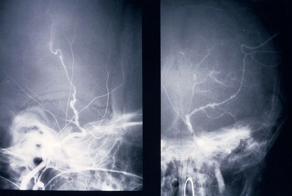 Infarct due to arteritis