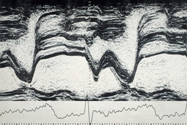 Mitral valve, prolapse