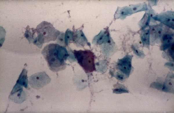 Gardinerella vaginalis bacteria, clue cell