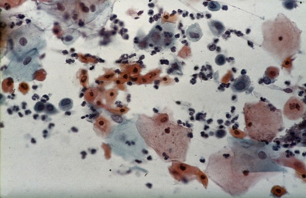 Wart virus infection