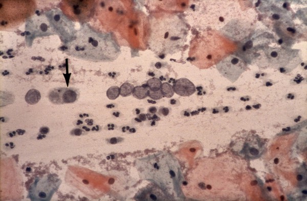 Adenocarcinoma