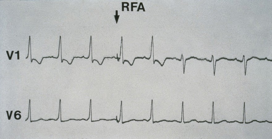 Wolff-Parkinson-White syndrome