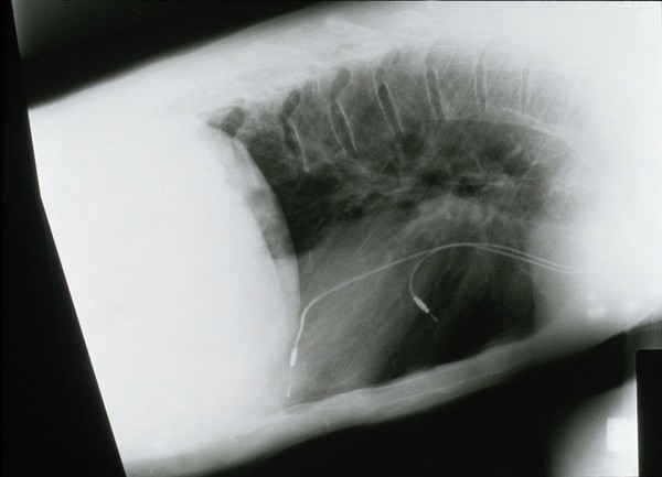 Pacemaker in situ, 1990