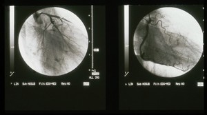 view Coronary disease, severe three vessel