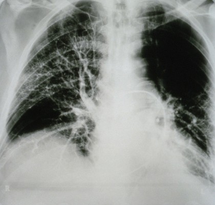 Embolus, pulmonary