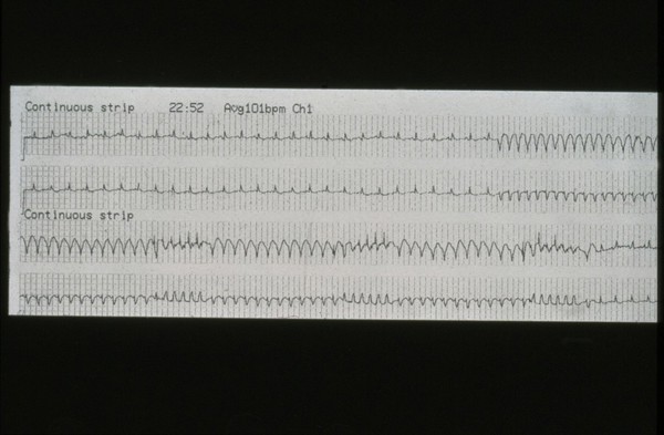 Implantable cardioverter defibrillator