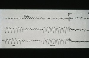 view Implantable cardioverter defibrillator