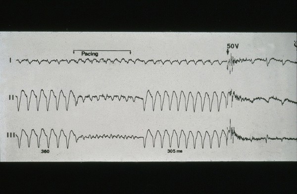 Implantable cardioverter defibrillator