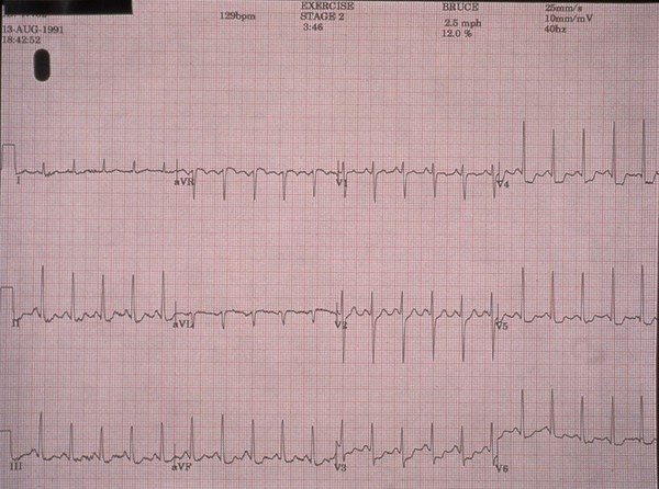 Coronary heart disease