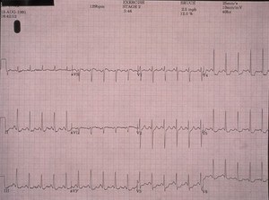 view Coronary heart disease