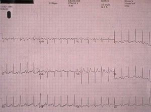 view Coronary heart disease