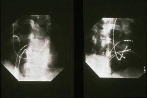 view Cardiac ablation