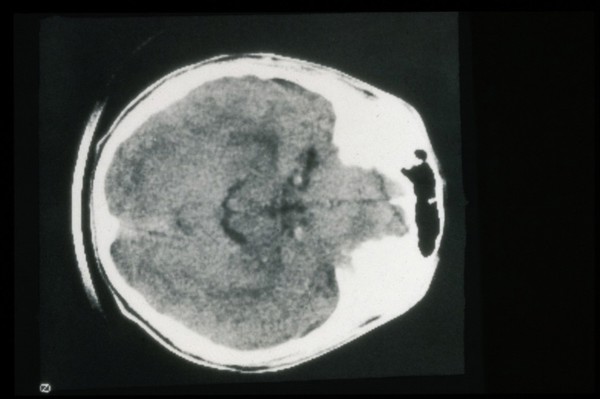 Aneurysms, carotid bilateral