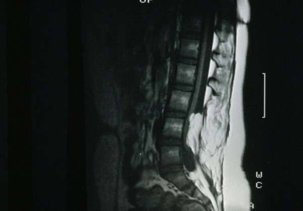 Lipoma and tethered cord