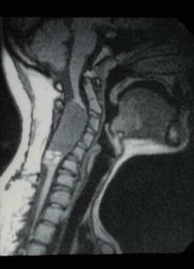 Demoid, Intra-Medullary