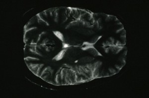 view Hemidystonia