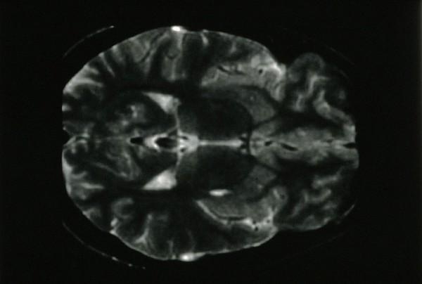 Hemidystonia