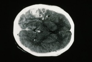 view Arterio Venous Malformation, Parietal (R)