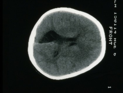 Infarct, Occipital (R), Mature