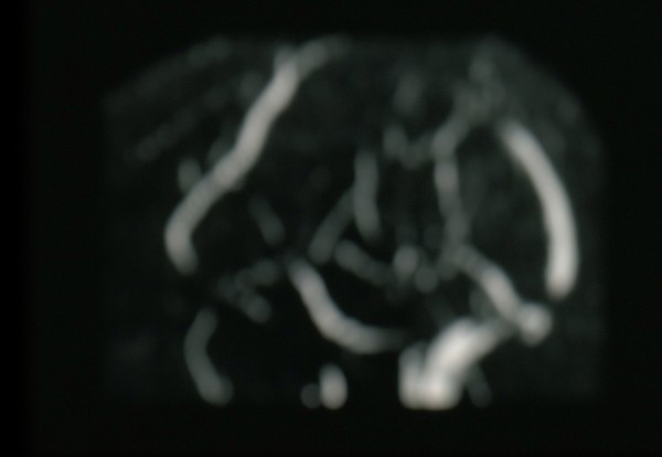 Thrombosis, Sagittal sinus