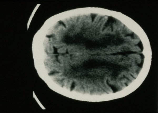 Hypertensive, vascular disease