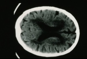 view Hypertensive, vascular disease