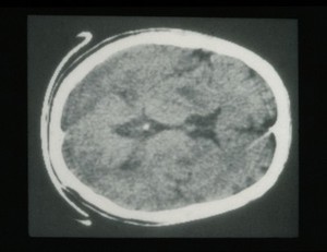 view Wilson's disease