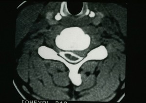 view Stenosis, Cervical disc and canal