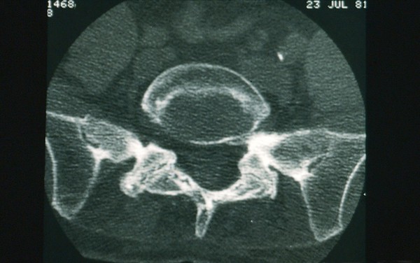 Ankylosing Spondylitis