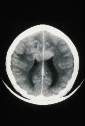 view MRI scan; brain cancer (glioma), corpus callosum