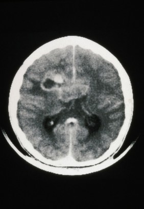 MRI scan; brain cancer (glioma), corpus callosum