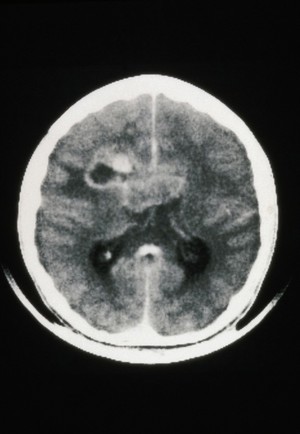 view MRI scan; brain cancer (glioma), corpus callosum