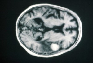 view MRI scan; brain cancer (meningioma)