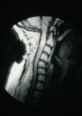 MRI scan; spinal cord cancer (glioma), cervical