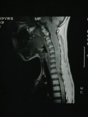 MRI scan; spinal cord cancer, cervical