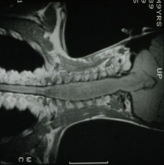 MRI scan; spinal cord cancer, cervical