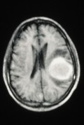 view MRI scan; brain cancer, metastasis