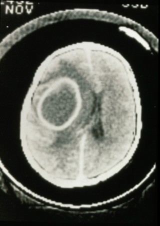 Abscess, Brain