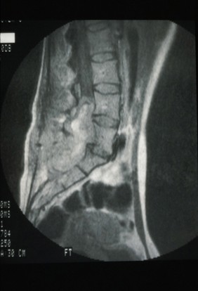 MRI scan; spinal cord tumour (neurofibroma)