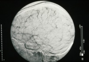 view Thrombosis, Sagittal sinus