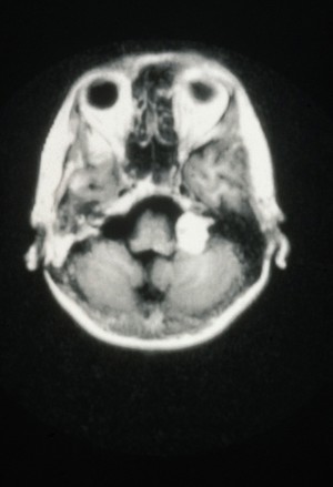 view Neuroma, Acoustic