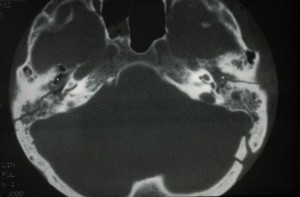 view Fracture of skull base