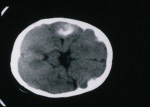 view MRI scan; brain cancer (oligodendroglioma)