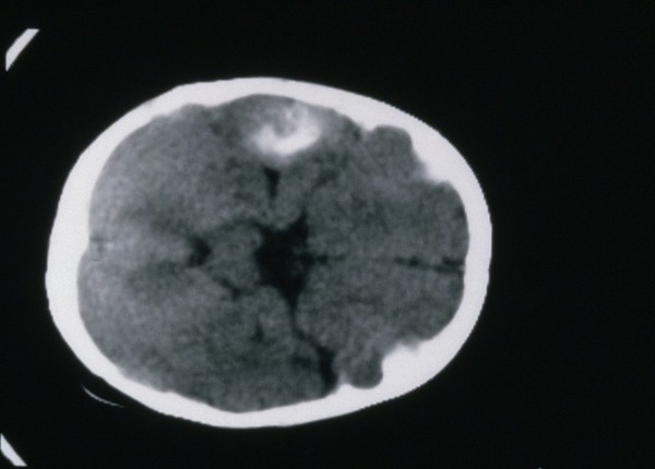 MRI scan; brain cancer (oligodendroglioma)