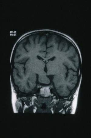view Hypothalamic hamartoma