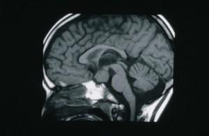 view Hypothalamic Hamartoma